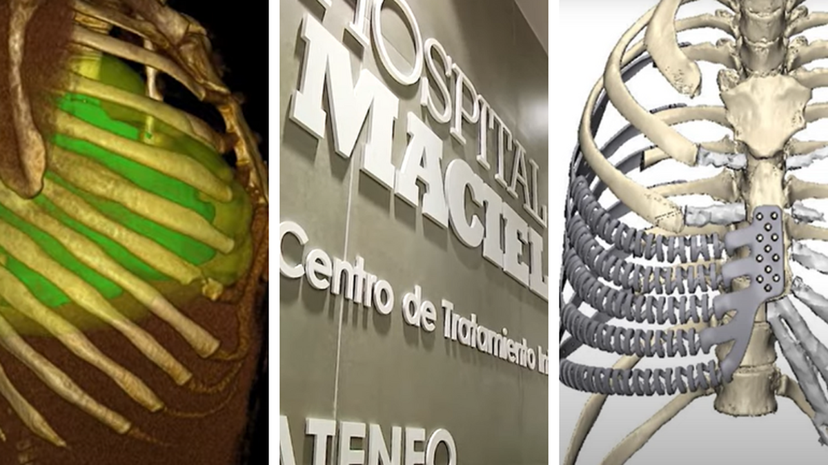 Inédita intervención torácica con prótesis 3D de titanio en el Hospital Maciel: un antes y un después en la salud pública uruguaya